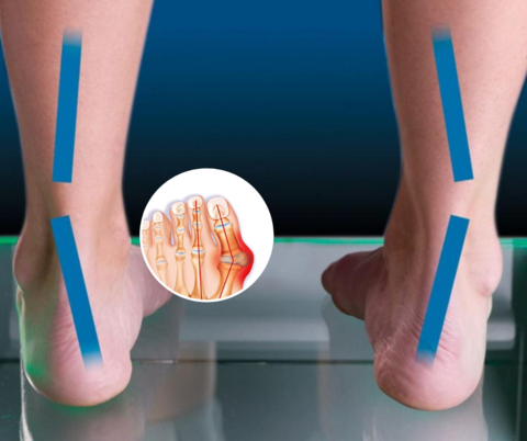 Orthopedic Hammer Toe Corrector (BUY 1 GET 1)